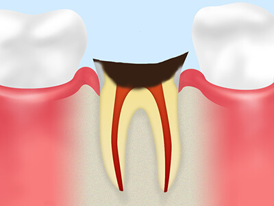 虫歯の症状と治療法