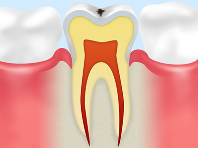 虫歯の症状と治療法