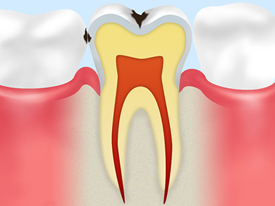 虫歯の症状と治療法