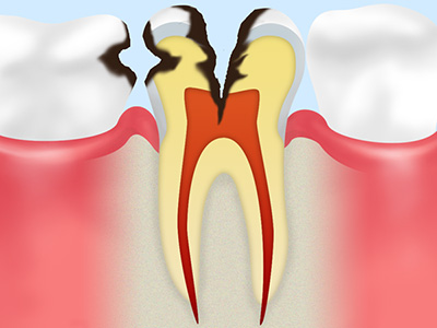 虫歯の症状と治療法