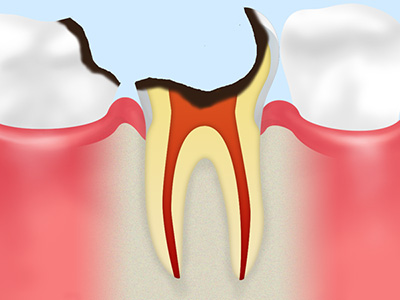 虫歯の症状と治療法