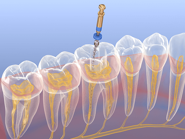 重度の虫歯には根管治療