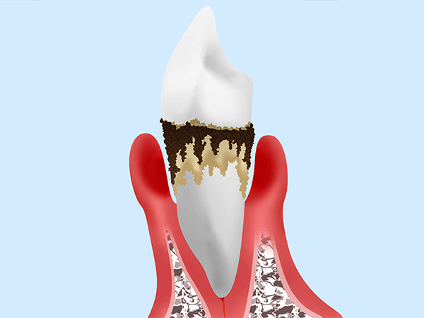 歯周病とは