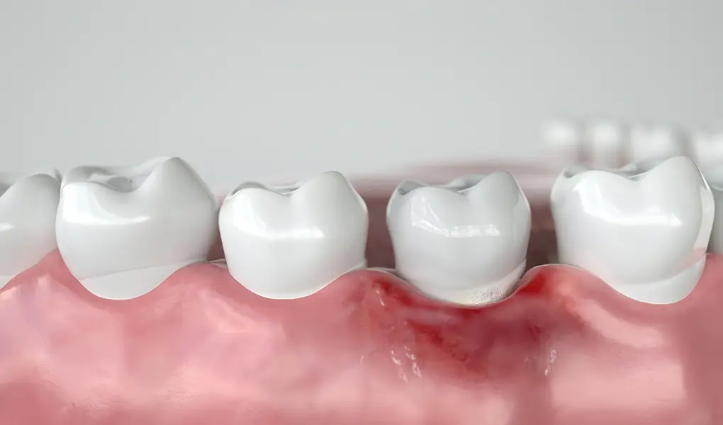 歯周病治療